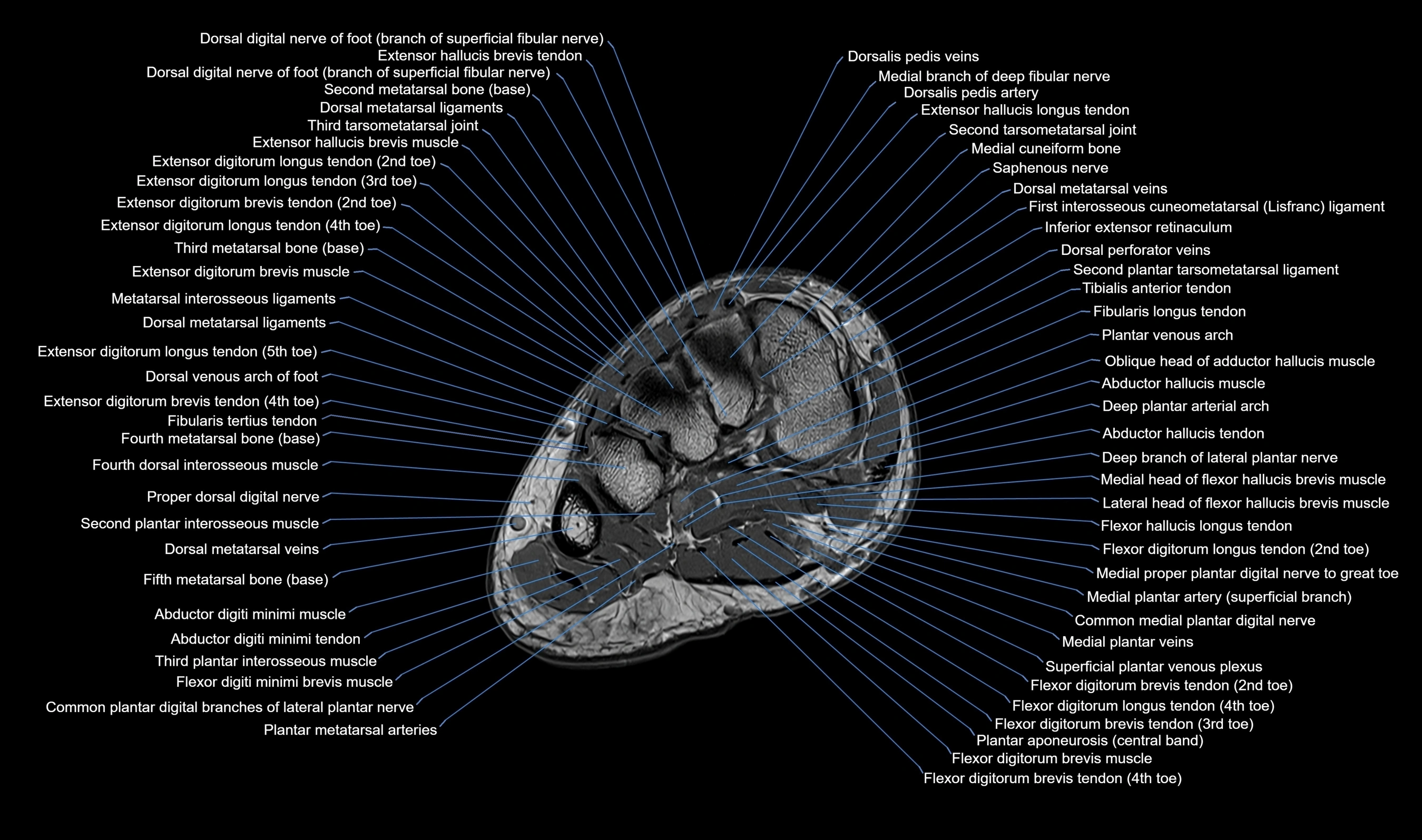 MRI mid foot axial cross sectional anatomy 3T  radiology  image-img-00001-00016.webp